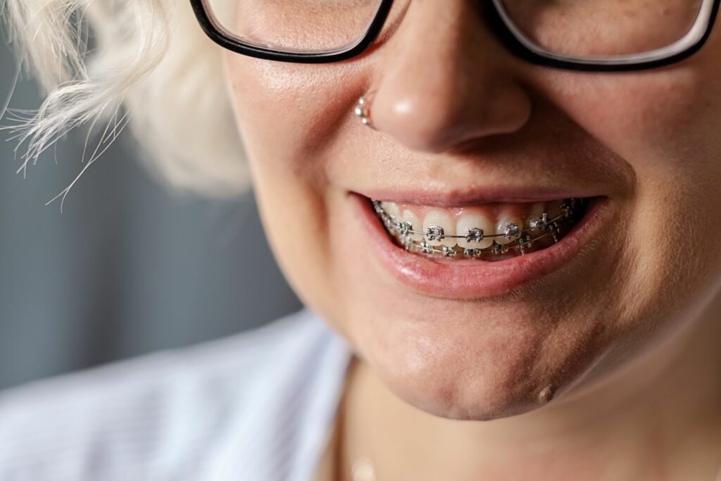 Ortodoncja dla dorosłych – nigdy nie jest za późno
